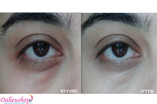 MartiDerm Platinum Eye Correct hiệu quả sử dụng